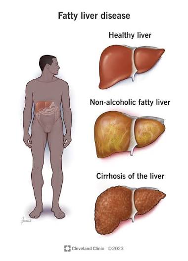 Liver Health